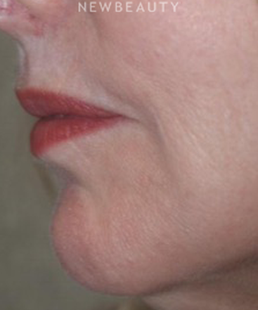 dr-marina-peredo-botox-b