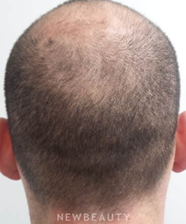 dr-marina-peredo-hair-loss-treatment-b