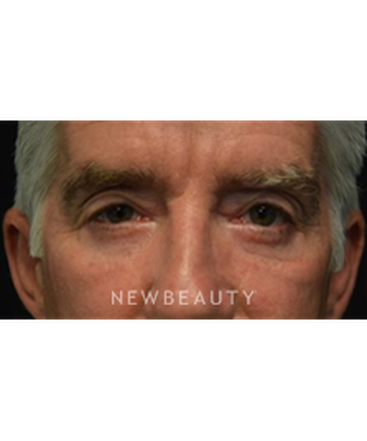 dr-jeffrey-b-wise-eyelift-b