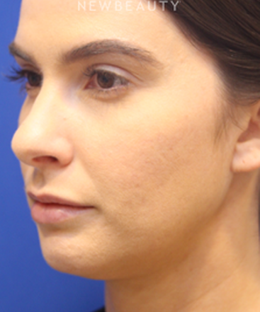 dr-jennifer-levine-lasers-b