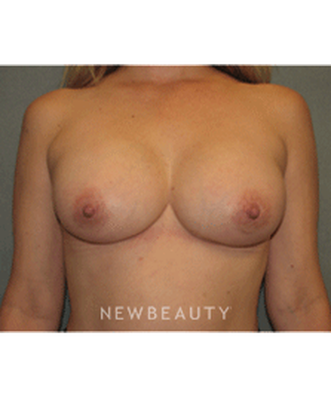 dr-sean-simon-breast-augmentation-b