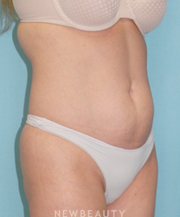 dr-sean-simon-smartlipo-b