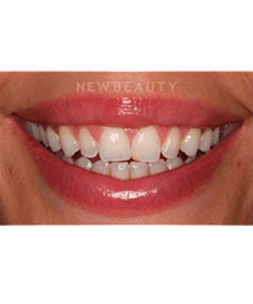 dr-laurence-rifkin-veneers-teeth-whitening-b