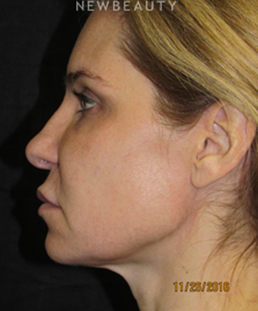 dr-joseph-grzeskiewicz-macs-facelift-b