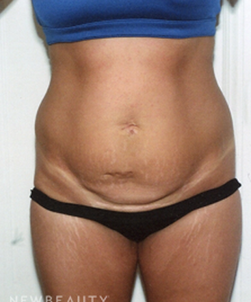 dr-david-rapaport-breast-augmentation-tummy-tuck-b