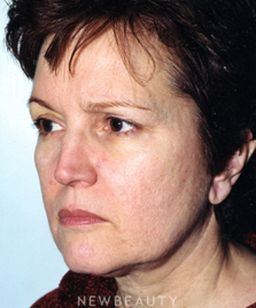 dr-david-rapaport-blepharoplasty-facelift-b