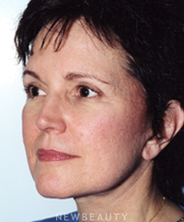 dr-david-rapaport-blepharoplasty-facelift-b