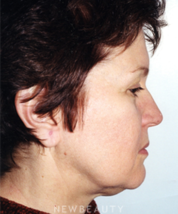 dr-david-blepharoplasty-facelift-b