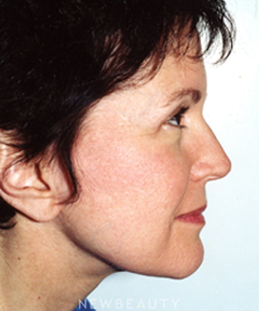 dr-david-blepharoplasty-facelift-b