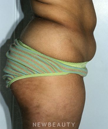 dr-david-rapaport-liposuction-b