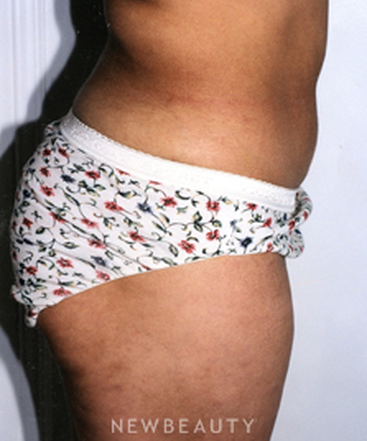 dr-david-rapaport-liposuction-b