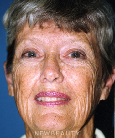 dr-david-rapaport-blepharoplasty-facelift-b