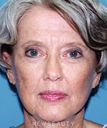 dr-david-rapaport-blepharoplasty-facelift-b
