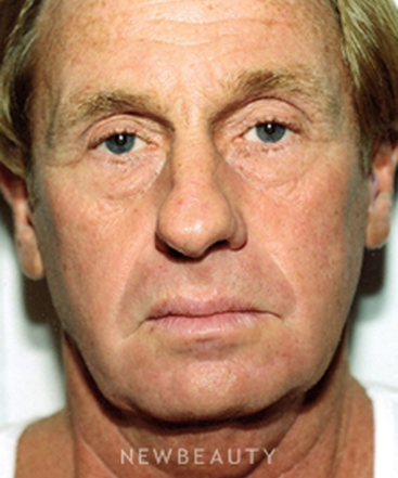 dr-david-rapaport-facelift-b