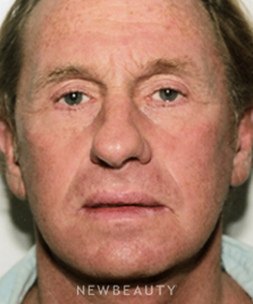 dr-david-rapaport-facelift-b