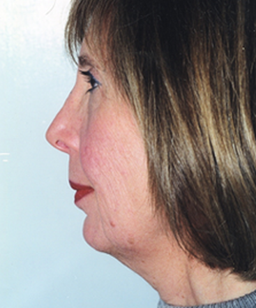 dr-david-rapaport-facelift-b