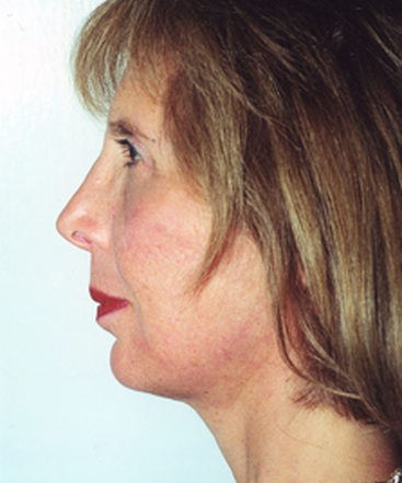 dr-david-rapaport-facelift-b