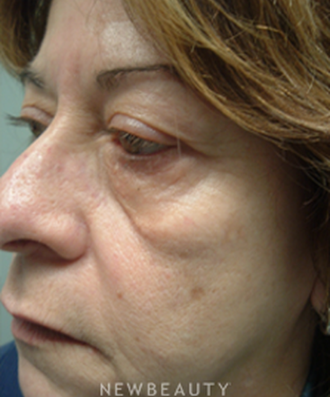 dr-marina-peredo-elos-injectionsliquid-lift-b