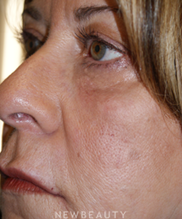 dr-marina-peredo-elos-injectionsliquid-lift-b