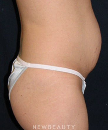 dr-tiffany-mccormack-tummy-tuck-b