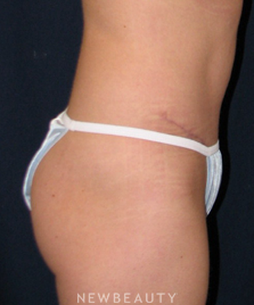 dr-tiffany-mccormack-tummy-tuck-b