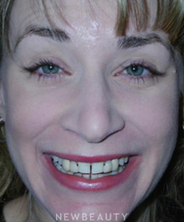 dr-guy-lewis-crowns-dental-implants-gum-contouring-b