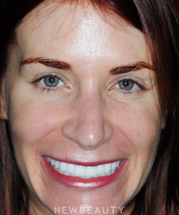 dr-guy-lewis-crowns-dental-implants-gum-contouring-b