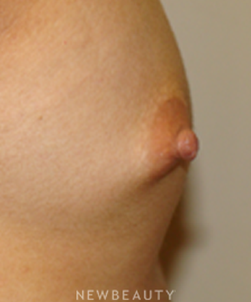 dr-sanjay-grover-nipple-reduction-b