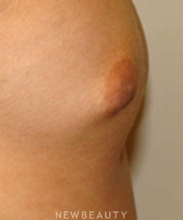 dr-sanjay-grover-nipple-reduction-b