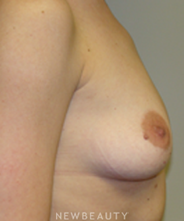 dr-sanjay-grover-breast-augmentation-b