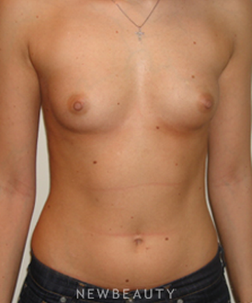 dr-michael-horn-breast-augmentation-b
