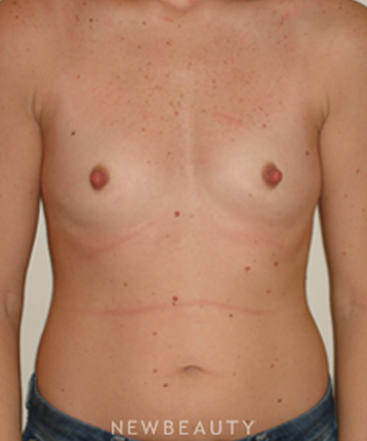 dr-michael-horn-breast-augmentation-b