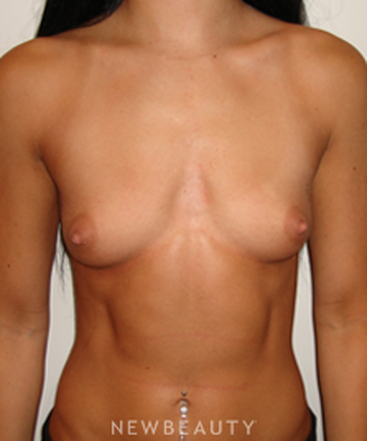 dr-michael-horn-breast-augmentation-b