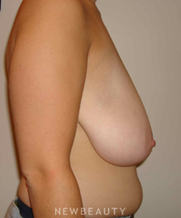 dr-michael-horn-breast-reduction-b