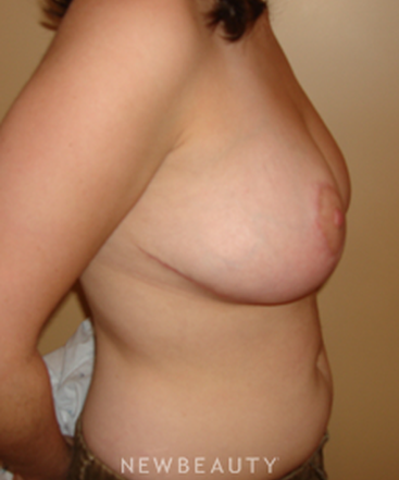 dr-michael-horn-breast-reduction-b