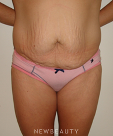 dr-michael-horn-tummy-tuck-b