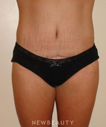 dr-michael-horn-tummy-tuck-b