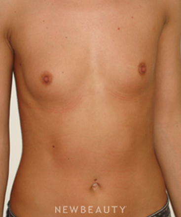 dr-michael-horn-breast-augmentation-b