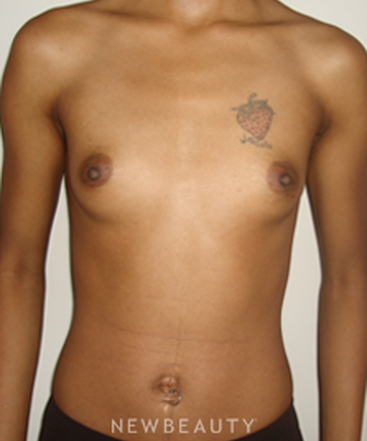 dr-michael-horn-breast-augmentation-b