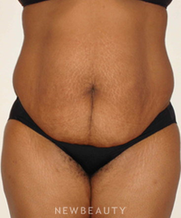 dr-michael-horn-tummy-tuck-b