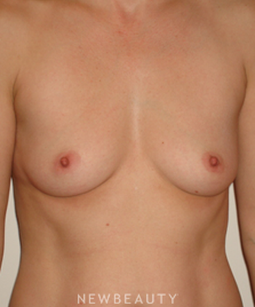 dr-michael-horn-breast-augmentation-b