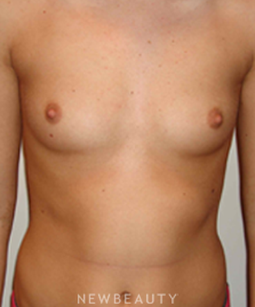 dr-michael-horn-breast-augmentation-b
