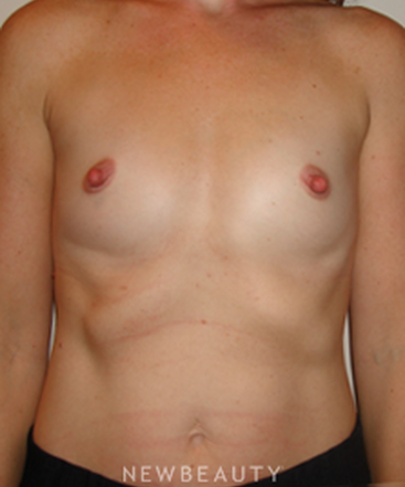 dr-michael-horn-breast-augmentation-b