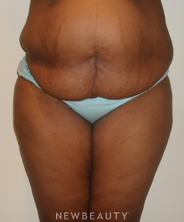 dr-michael-horn-tummy-tuck-liposuction-b