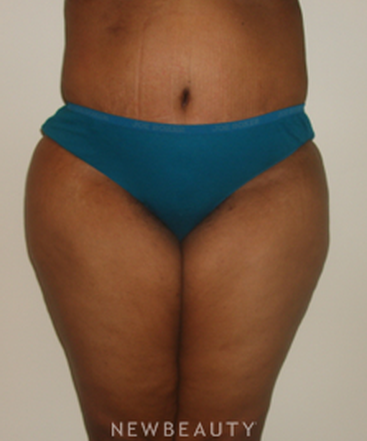 dr-michael-horn-tummy-tuck-liposuction-b