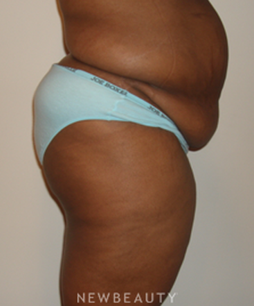 dr-michael-horn-tummy-tuck-liposuction-b