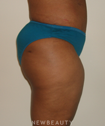 dr-michael-horn-tummy-tuck-liposuction-b