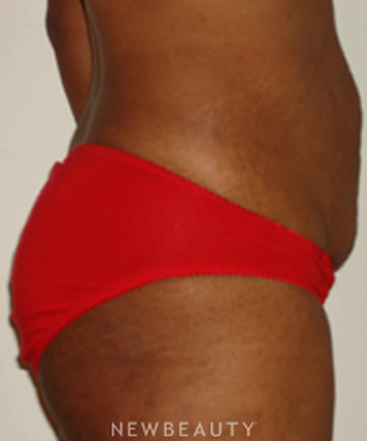 dr-michael-horn-tummy-tuck-b