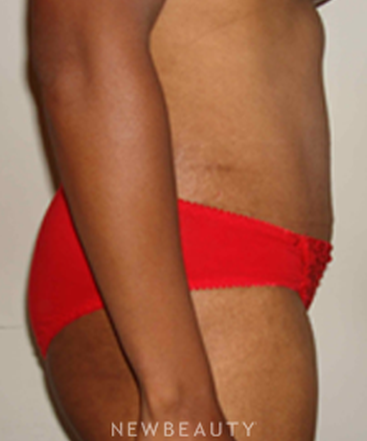 dr-michael-horn-tummy-tuck-b