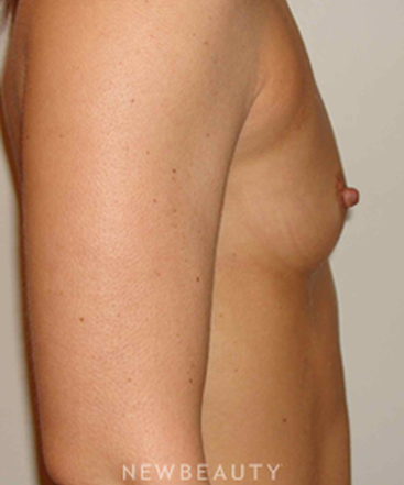 dr-michael-horn-breast-augmentation-b